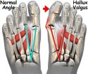 Hallux valgus